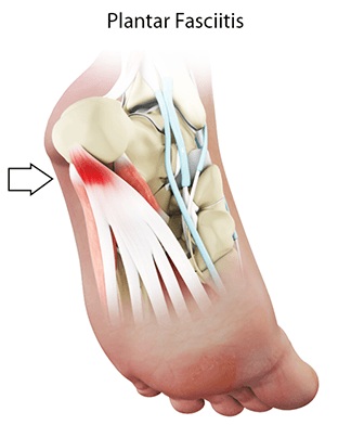 Plantar Fascitis