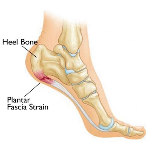 heel_pain heel pain