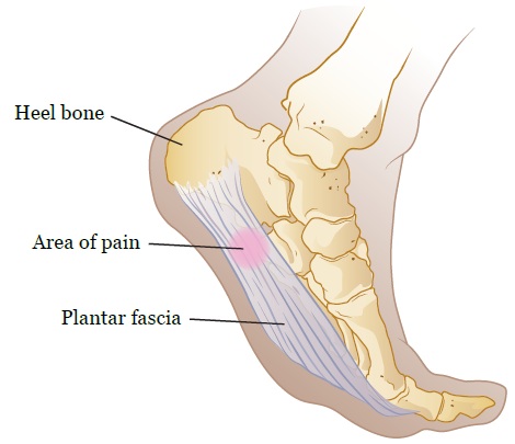 heel_pain2_0