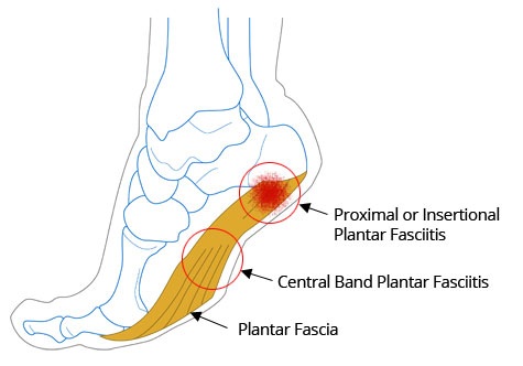 heel_pain3_0